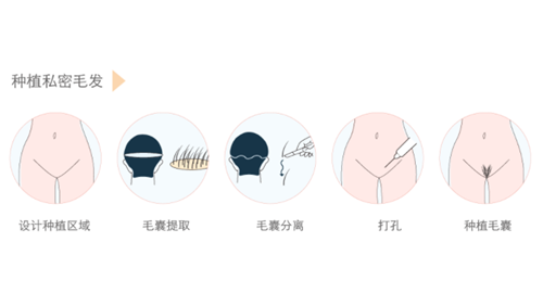 毛發(fā)移植