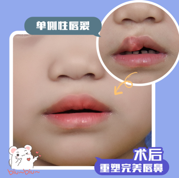 唇裂修復