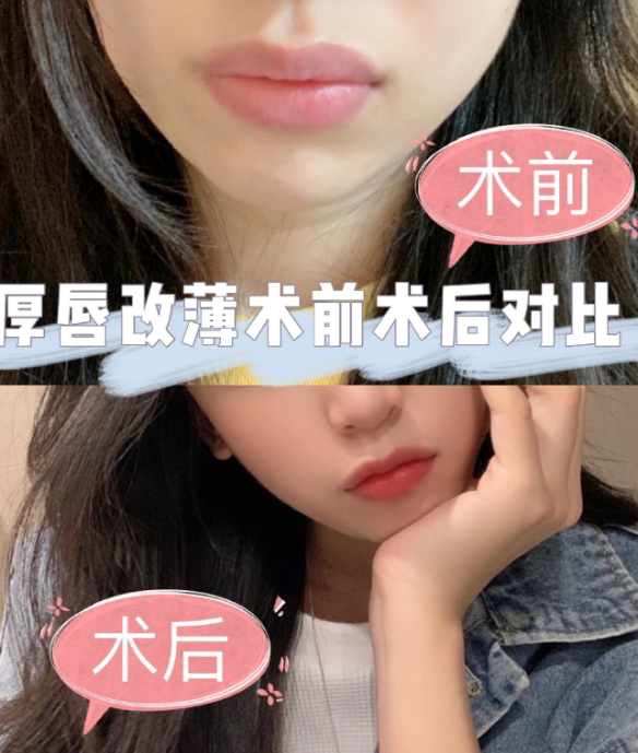 厚唇改薄
