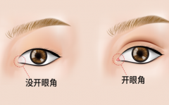 微創(chuàng)開(kāi)眼角