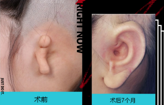 全耳再造