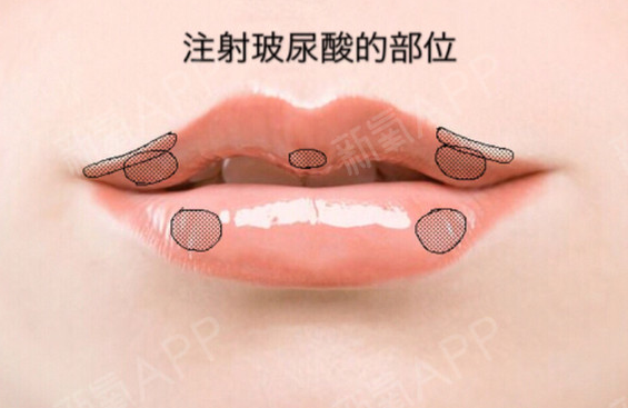 玻尿酸豐唇