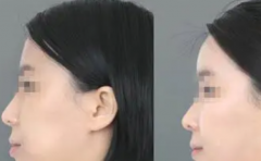 假體豐額頭