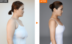 巨大乳房縮小
